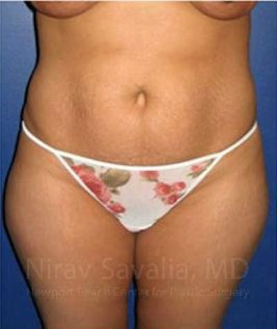 Abdominoplasty Tummy Tuck Before & After Gallery - Patient 1655614 - Before