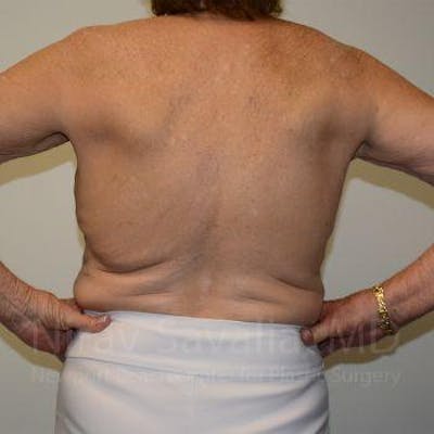 Breast Lift without Implants Before & After Gallery - Patient 1655616 - Before