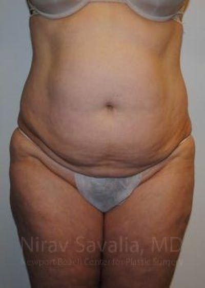 Abdominoplasty Tummy Tuck Before & After Gallery - Patient 1655617 - Before