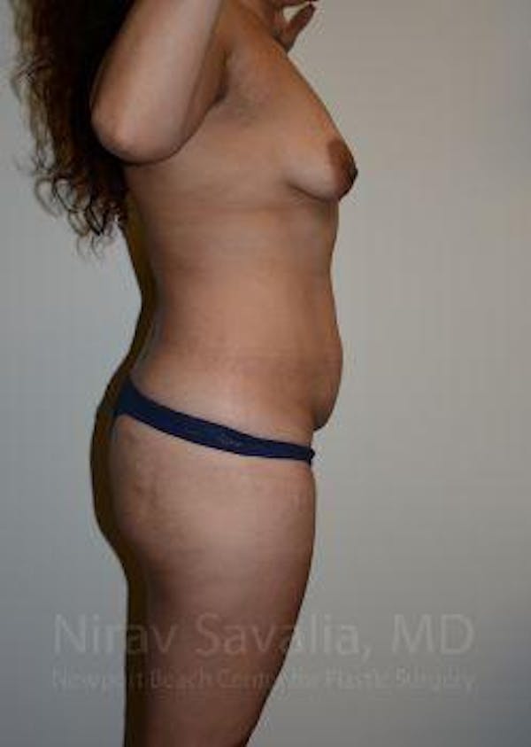 Breast Lift with Implants Before & After Gallery - Patient 1655619 - Before