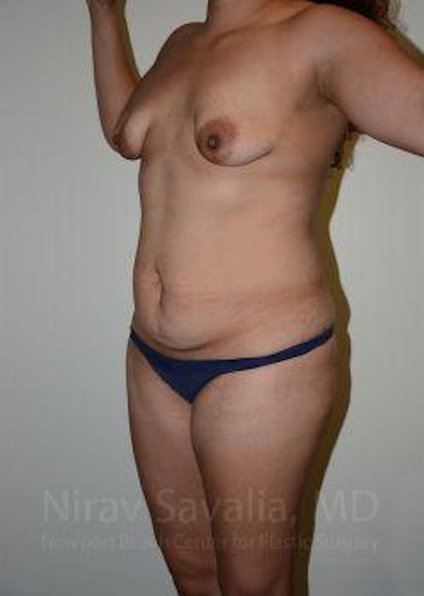 Mastectomy Reconstruction Before & After Gallery - Patient 1655619 - Before