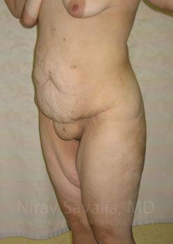 Liposuction Before & After Gallery - Patient 1655620 - Before