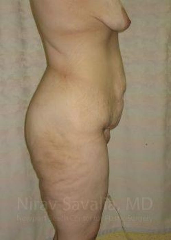 Oncoplastic Reconstruction Before & After Gallery - Patient 1655620 - Before