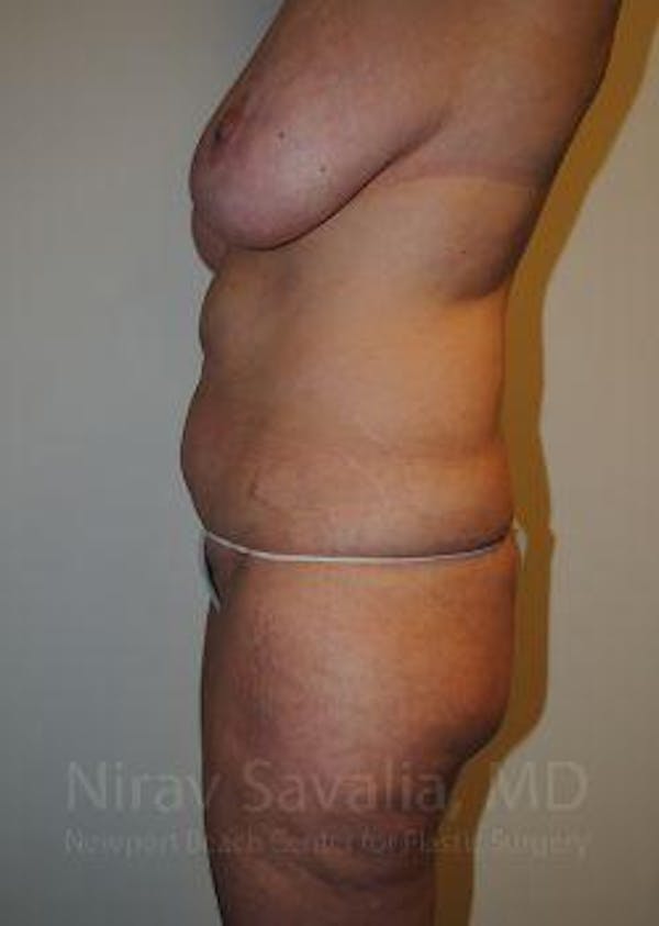 Breast Lift without Implants Before & After Gallery - Patient 1655623 - Before