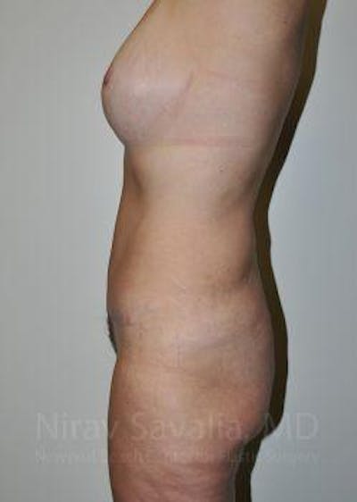 Liposuction Before & After Gallery - Patient 1655623 - After