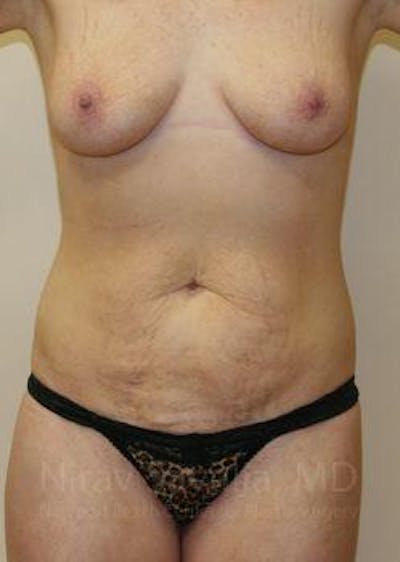 Oncoplastic Reconstruction Before & After Gallery - Patient 1655627 - Before