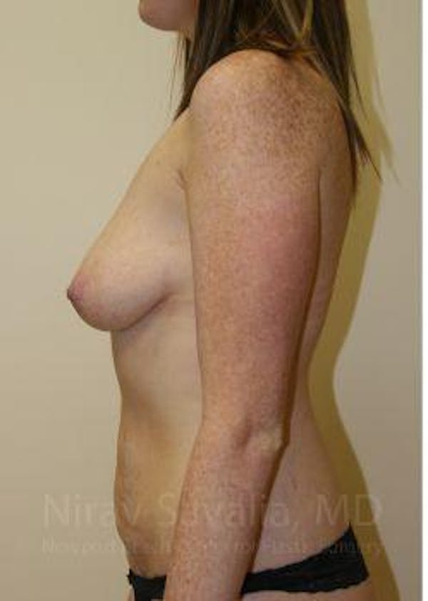 Oncoplastic Reconstruction Before & After Gallery - Patient 1655627 - Before