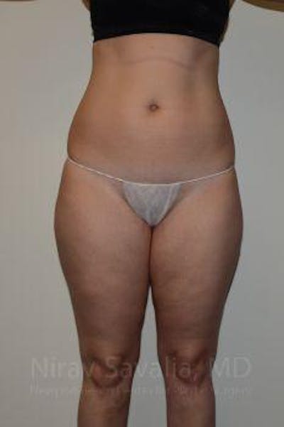 Thigh Lift Before & After Gallery - Patient 1655629 - Before