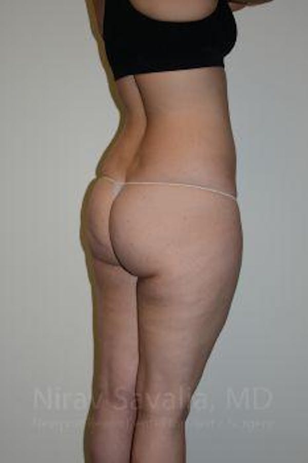 Body Contouring after Weight Loss Before & After Gallery - Patient 1655629 - Before