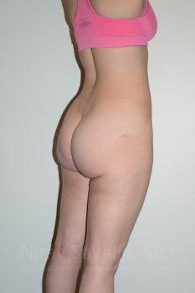 Liposuction Before & After Gallery - Patient 1655629 - After