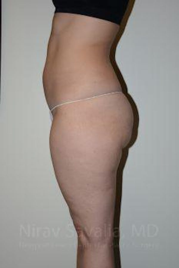 Body Contouring after Weight Loss Before & After Gallery - Patient 1655629 - Before