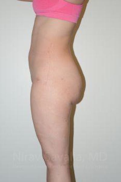 Thigh Lift Before & After Gallery - Patient 1655629 - After