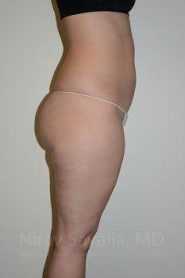 Thigh Lift Before & After Gallery - Patient 1655629 - Before