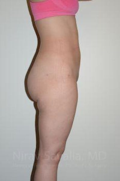 Thigh Lift Before & After Gallery - Patient 1655629 - After