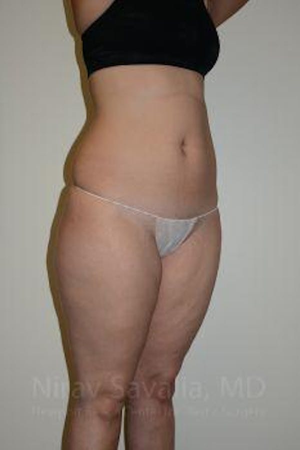 Abdominoplasty Tummy Tuck Before & After Gallery - Patient 1655629 - Before