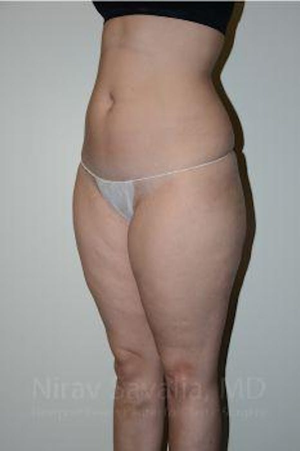 Abdominoplasty Tummy Tuck Before & After Gallery - Patient 1655629 - Before