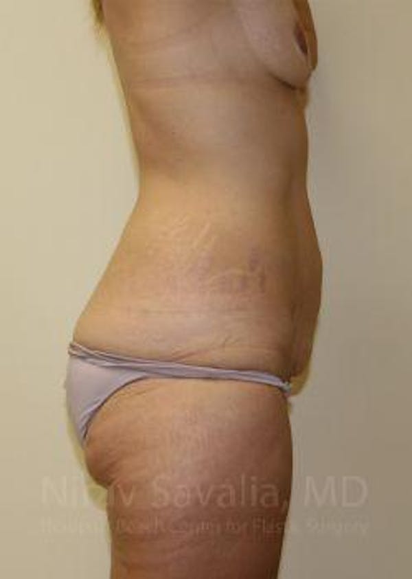 Breast Lift without Implants Before & After Gallery - Patient 1655631 - Before