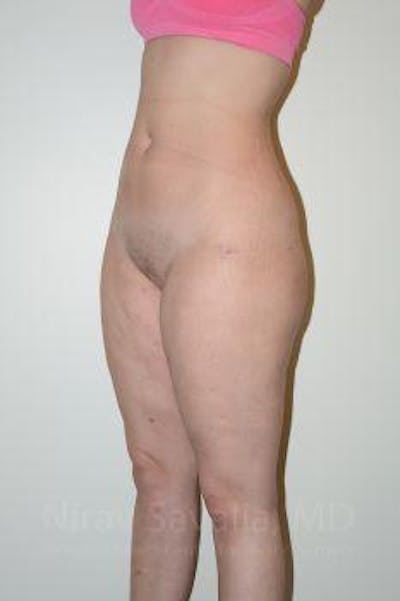 Thigh Lift Before & After Gallery - Patient 1655629 - After