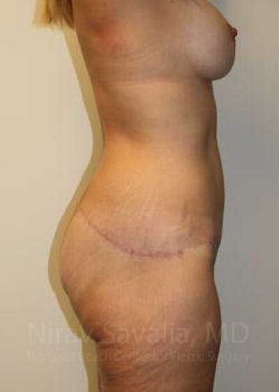 Breast Lift without Implants Before & After Gallery - Patient 1655631 - After