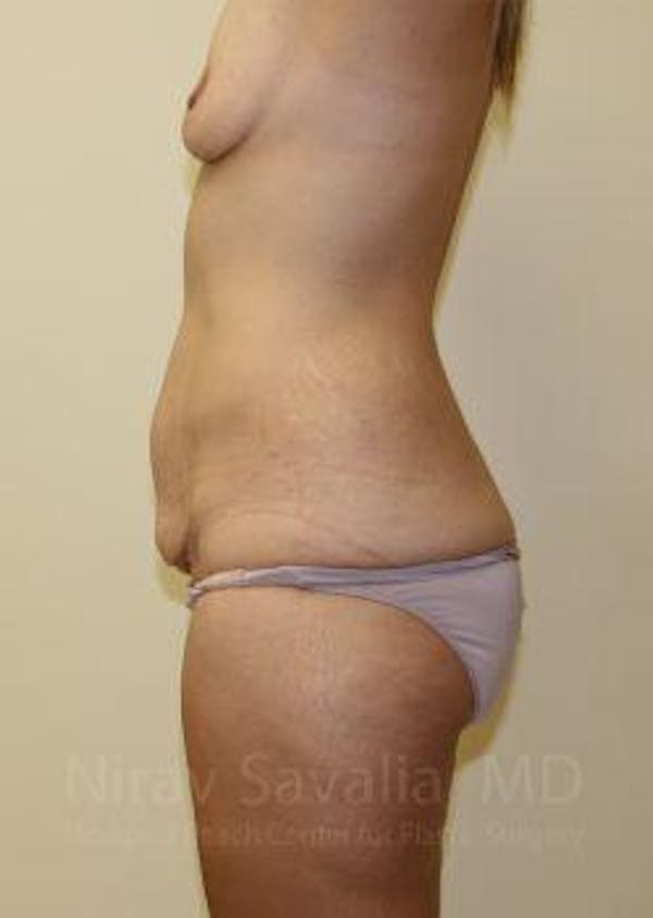 Breast Explantation En Bloc Capsulectomy Before & After Gallery - Patient 1655630 - Before