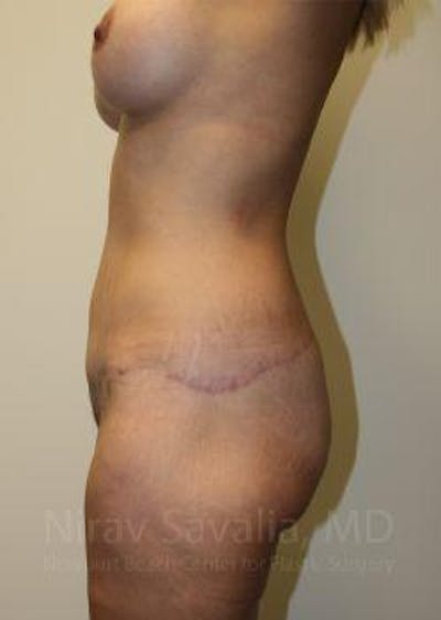 Breast Lift with Implants Before & After Gallery - Patient 1655631 - After