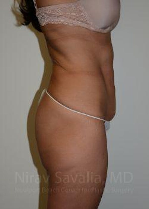 Breast Explantation En Bloc Capsulectomy Before & After Gallery - Patient 1655633 - Before