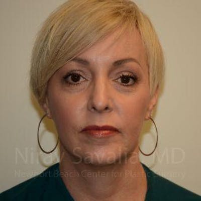 Oncoplastic Reconstruction Before & After Gallery - Patient 1655632 - Before