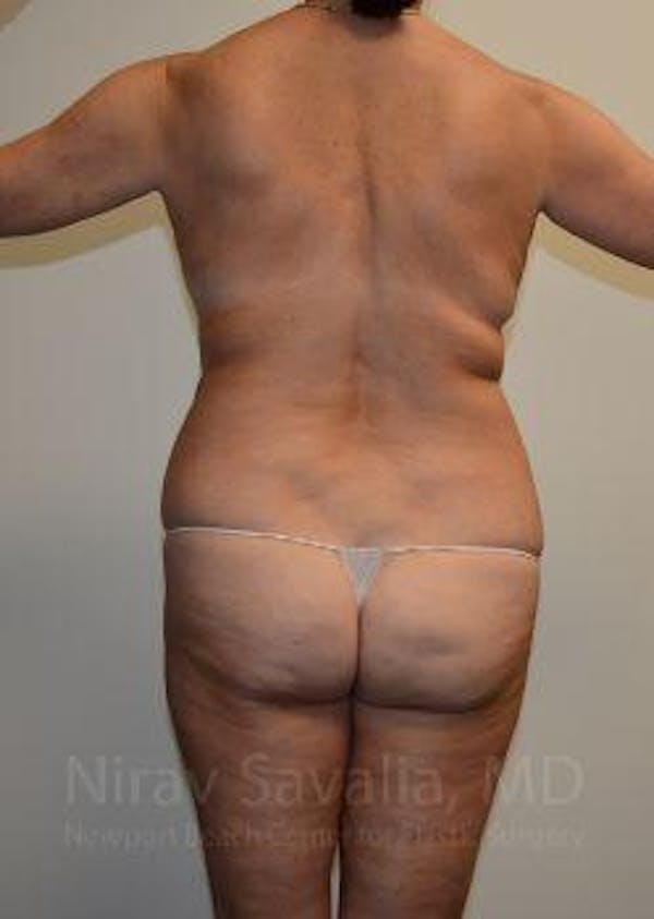 Liposuction Before & After Gallery - Patient 1655635 - Before