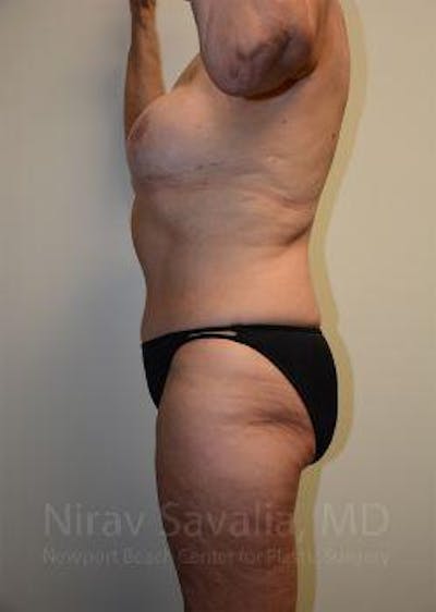 Mastectomy Reconstruction Before & After Gallery - Patient 1655634 - After