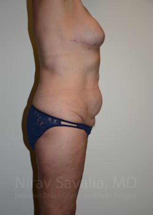 Mastectomy Reconstruction Before & After Gallery - Patient 1655634 - Before