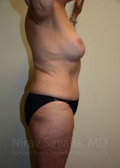 Liposuction Before & After Gallery - Patient 1655634 - After