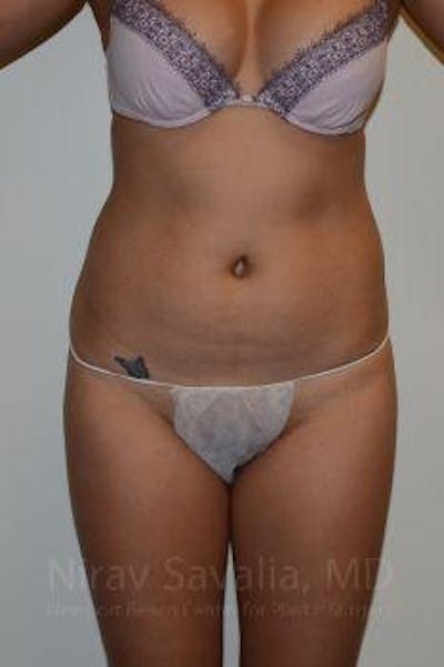 Breast Lift without Implants Before & After Gallery - Patient 1655637 - Before