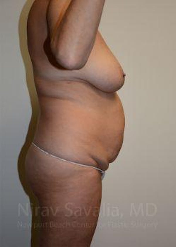 Breast Reduction Before & After Gallery - Patient 1655635 - Before
