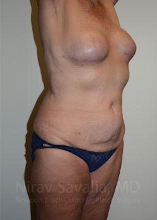 Chin Implants Before & After Gallery - Patient 1655634 - Before