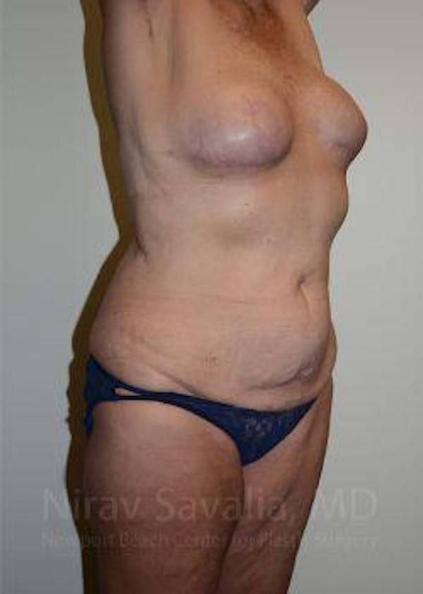 Mastectomy Reconstruction Before & After Gallery - Patient 1655634 - Before