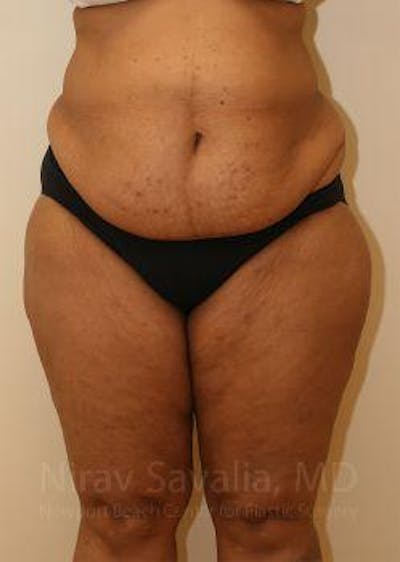 Thigh Lift Before & After Gallery - Patient 1655636 - Before