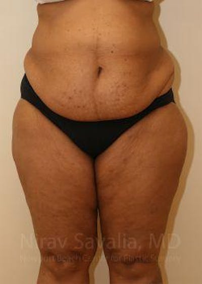 Abdominoplasty Tummy Tuck Before & After Gallery - Patient 1655636 - Before