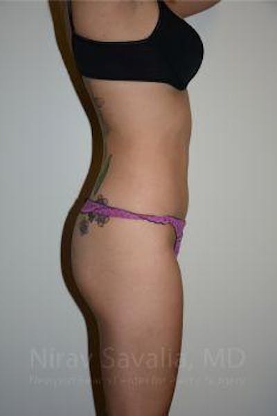 Thigh Lift Before & After Gallery - Patient 1655637 - After