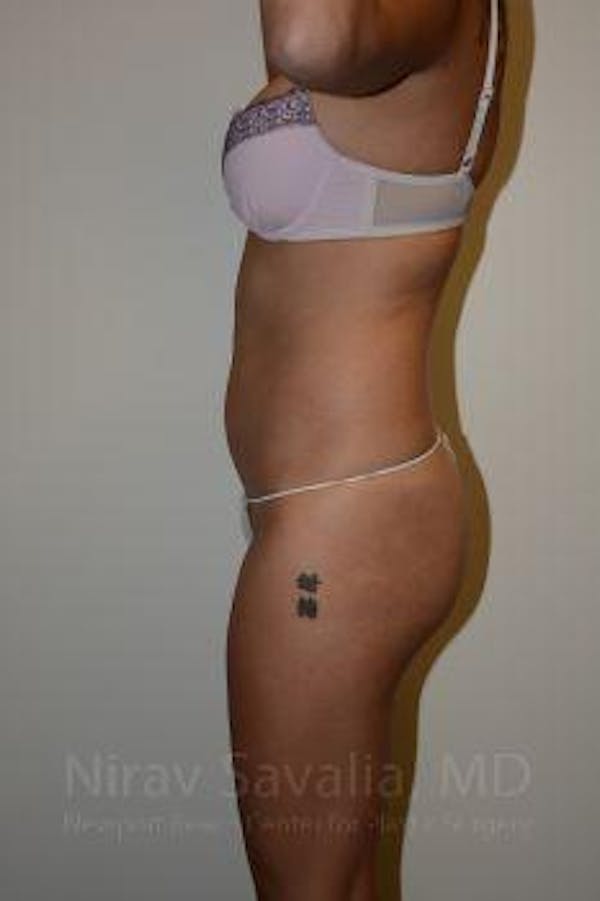 Body Contouring after Weight Loss Before & After Gallery - Patient 1655637 - Before