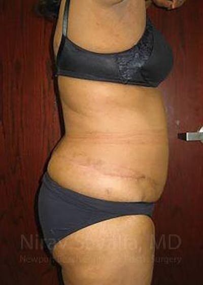 Abdominoplasty Tummy Tuck Before & After Gallery - Patient 1655636 - After