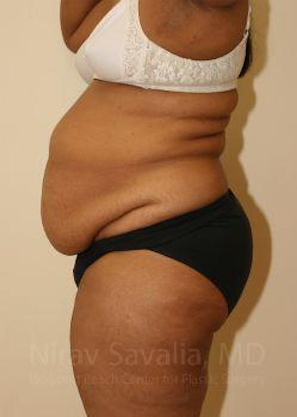 Abdominoplasty Tummy Tuck Before & After Gallery - Patient 1655636 - Before