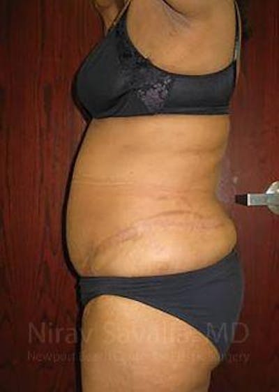 Mastectomy Reconstruction Before & After Gallery - Patient 1655636 - After