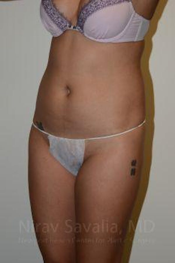 Liposuction Before & After Gallery - Patient 1655637 - Before