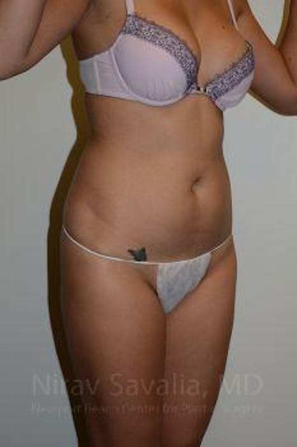 Body Contouring after Weight Loss Before & After Gallery - Patient 1655637 - Before