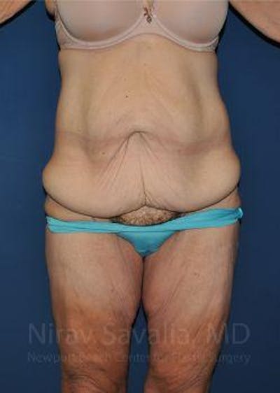 Oncoplastic Reconstruction Before & After Gallery - Patient 1655638 - Before