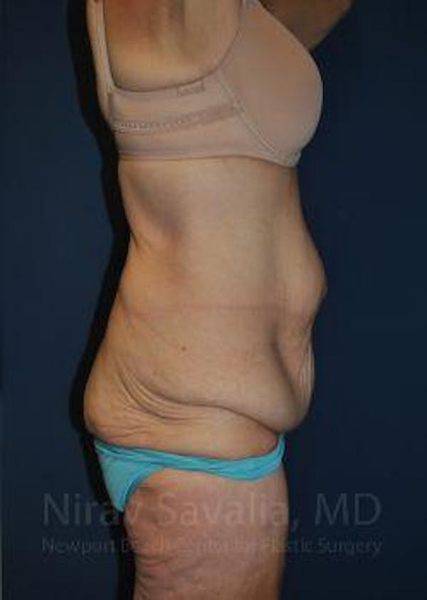 Breast Explantation En Bloc Capsulectomy Before & After Gallery - Patient 1655638 - Before