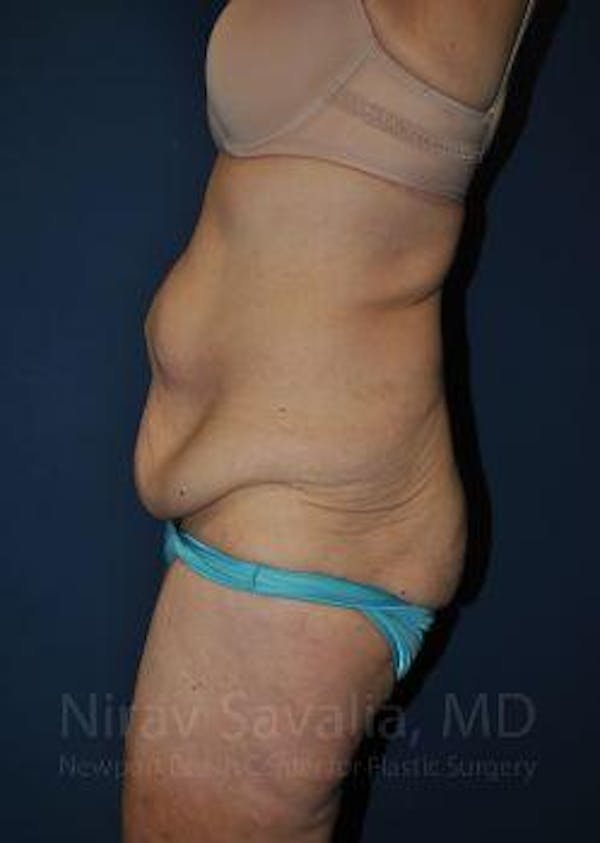 Breast Explantation En Bloc Capsulectomy Before & After Gallery - Patient 1655638 - Before