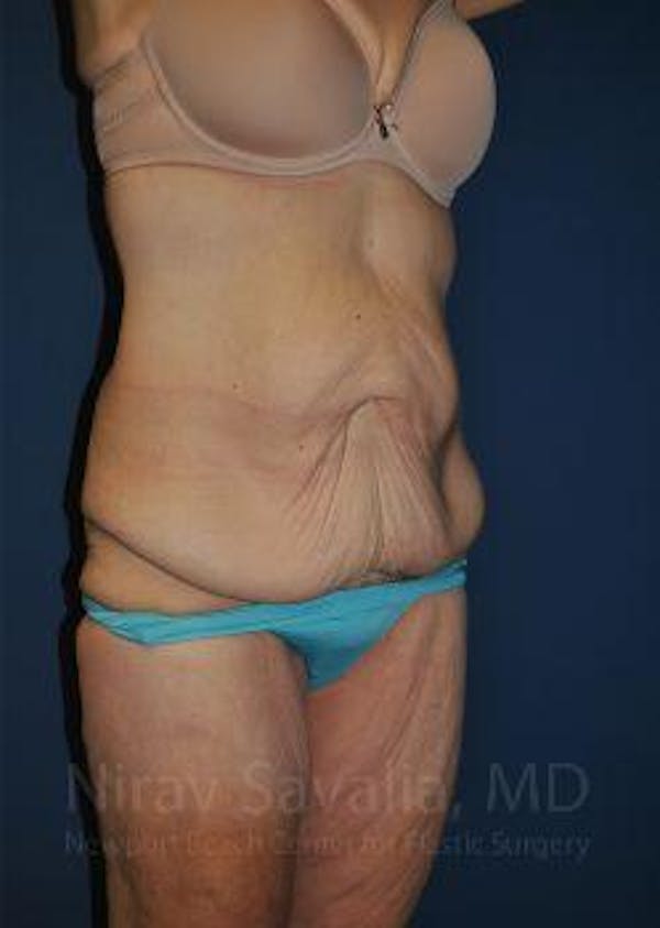 Oncoplastic Reconstruction Before & After Gallery - Patient 1655638 - Before