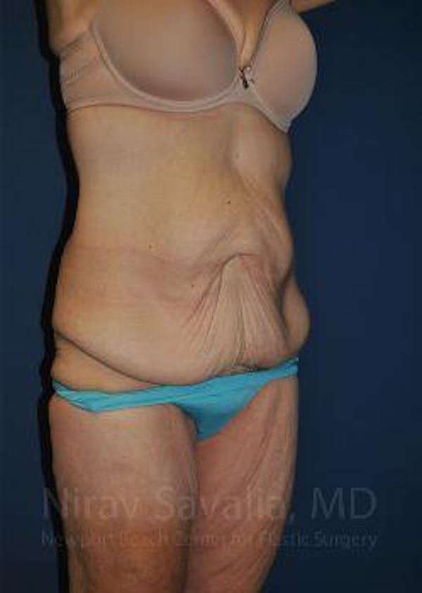 Breast Reduction Before & After Gallery - Patient 1655640 - Before
