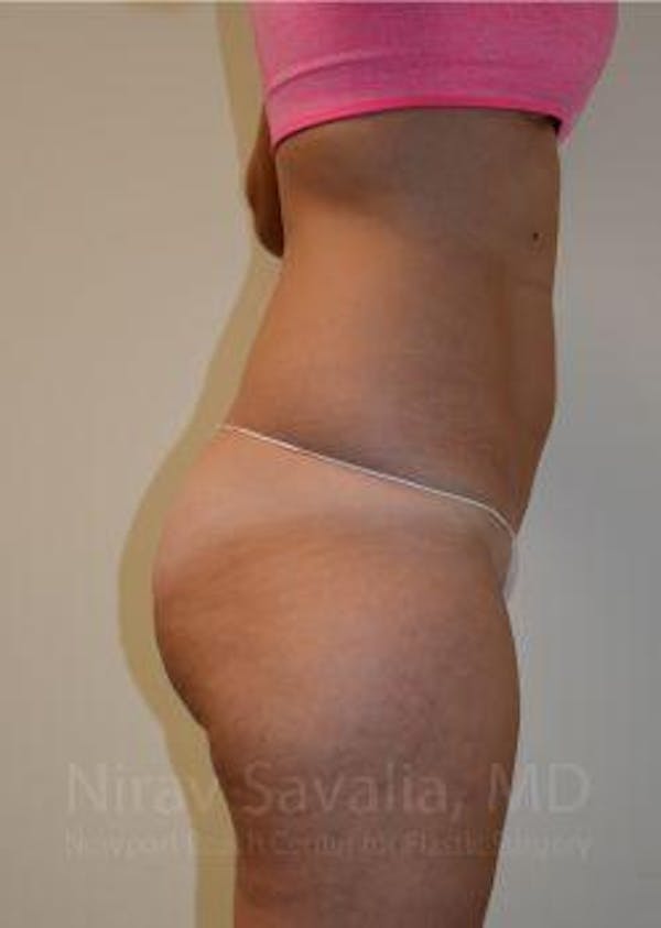 Breast Reduction Before & After Gallery - Patient 1655642 - Before